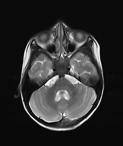 File:Acute disseminating encephalomyelitis with bilateral optic neuritis (Radiopaedia 79676-92886 Axial T2 7).jpg