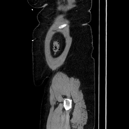 Acute diverticulitis - transverse colon (Radiopaedia 87063-103327 Sagittal C+ portal venous phase 194).jpg