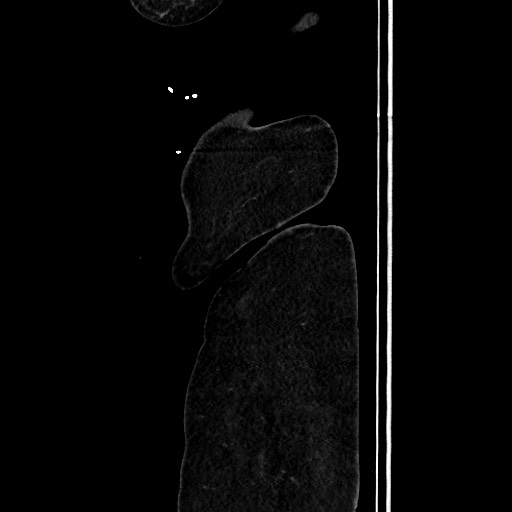 Acute diverticulitis - transverse colon (Radiopaedia 87063-103327 Sagittal C+ portal venous phase 217).jpg