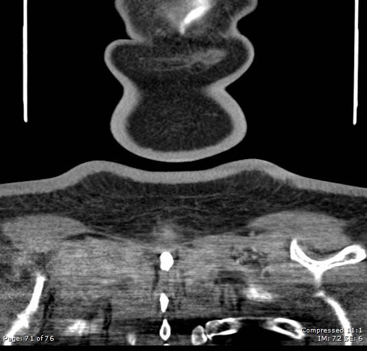 Acute epiglottitis (Radiopaedia 54375-60590 Coronal C+ arterial phase 71).jpg