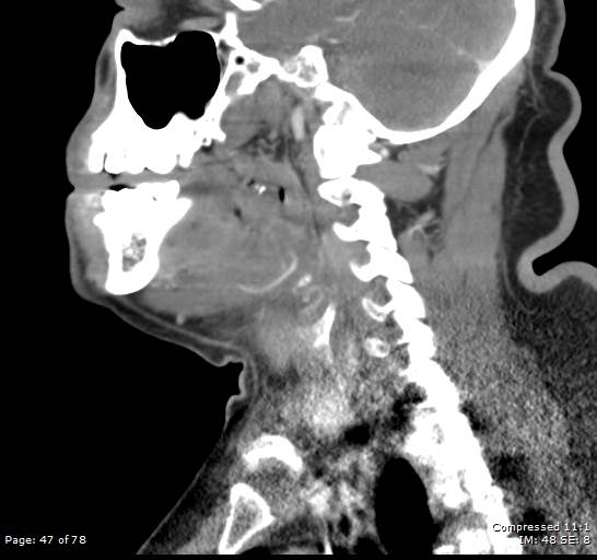 Acute epiglottitis (Radiopaedia 54375-60590 Sagittal C+ arterial phase 47).jpg