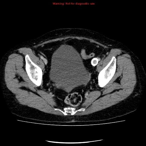 File:Acute gangrenous cholecystitis (Radiopaedia 10123-10661 Axial C+ portal venous phase 89).jpg