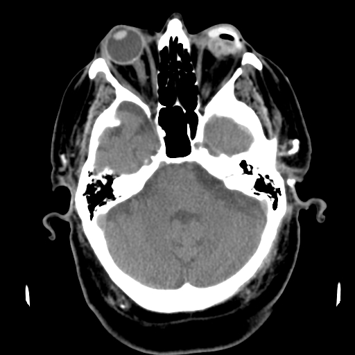 Acute hemorrhagic stroke (Radiopaedia 17507-17223 Axial non-contrast 14).jpg