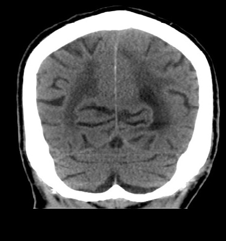 Acute left anterior cerebral artery territory infarction (Radiopaedia 51785-57578 Coronal non-contrast 47).jpg