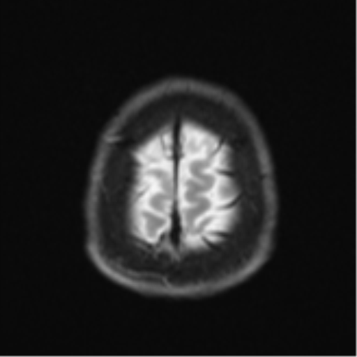 Acute left middle cerebral artery territory infarct with clot retrieval (Radiopaedia 47732-52433 Axial DWI 28).png