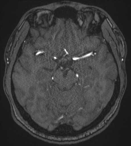Acute left middle cerebral artery territory infarct with clot retrieval (Radiopaedia 47732-52433 Axial MRA 24).png