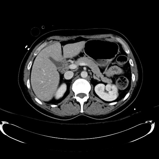 File:Acute myocardial infarction in CT (Radiopaedia 39947-42415 Axial C+ portal venous phase 42).jpg