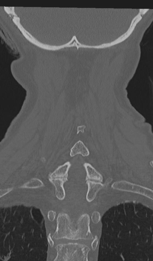 Acute on chronic subdural hematoma and thoracic vertebral injury in a multitrauma patient (Radiopaedia 31698-32619 Coronal bone window 52).jpg