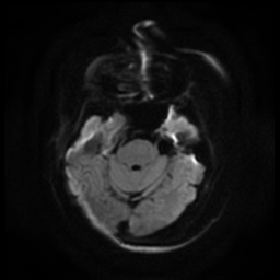 Acute otitis externa (Radiopaedia 57296-64236 Axial DWI 4).jpg