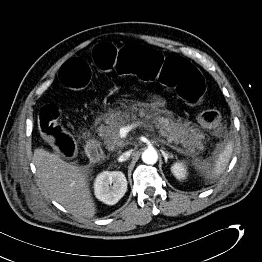 File:Acute pancreatic necrosis (Radiopaedia 13560-13486 Axial C+ portal venous phase 55).jpg