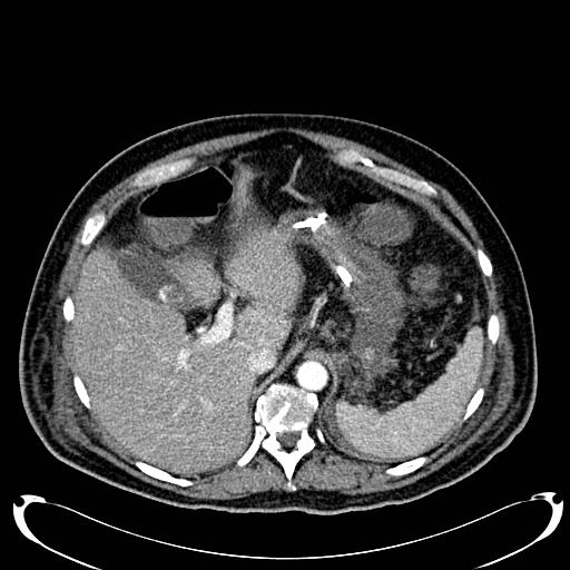 Acute pancreatic necrosis (Radiopaedia 13560-18500 Axial C+ portal venous phase 38).jpg