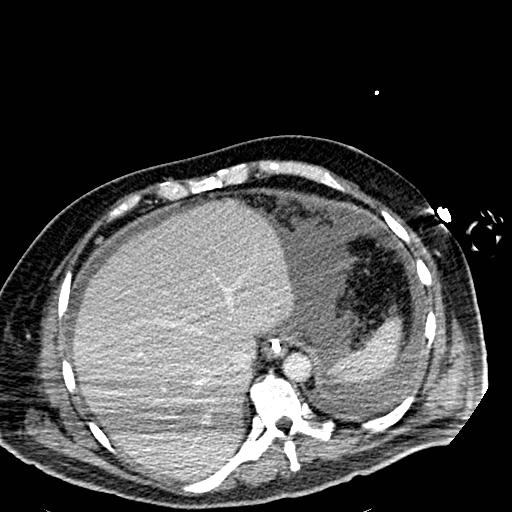 File:Acute pancreatic necrosis (Radiopaedia 13560-18501 Axial C+ portal venous phase 14).jpg
