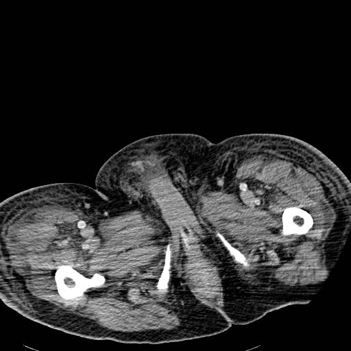 File:Acute pancreatic necrosis (Radiopaedia 13560-18501 Axial C+ portal venous phase 163).jpg