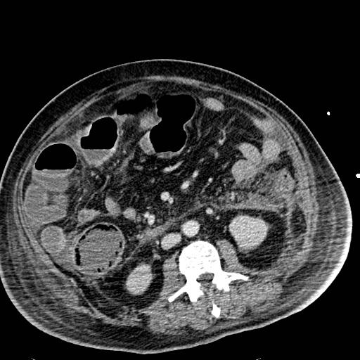 File:Acute pancreatic necrosis (Radiopaedia 13560-18501 Axial C+ portal venous phase 75).jpg