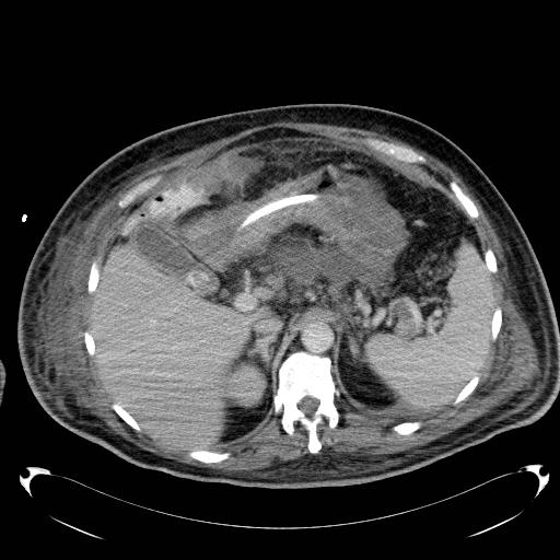 Acute pancreatic necrosis (Radiopaedia 13560-18503 Axial C+ portal venous phase 20).jpg
