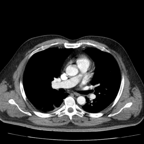 Acute pancreatitis (Radiopaedia 26663-26813 Axial C+ arterial phase 1).jpg