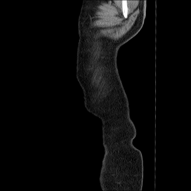 Acute pancreatitis (Radiopaedia 26663-26813 Sagittal C+ portal venous phase 1).jpg