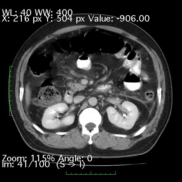 File:Acute pancreatitis (Radiopaedia 34043-35276 Axial C+ portal venous phase 41).jpg