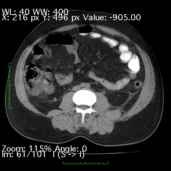 Acute pancreatitis (Radiopaedia 34043-35276 Axial non-contrast 61).jpg