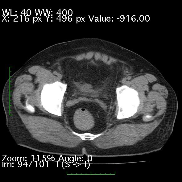 Acute pancreatitis (Radiopaedia 34043-35276 Axial non-contrast 94).jpg