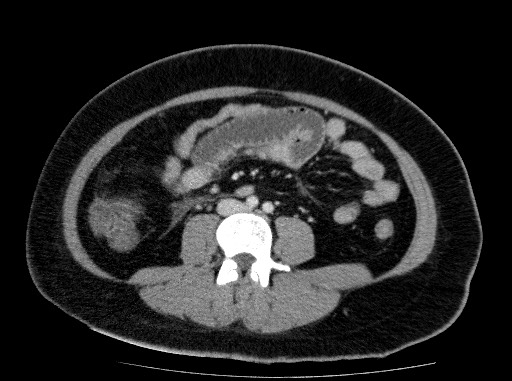 Acute pancreatitis (Radiopaedia 69236-79012 Axial C+ portal venous phase 55).jpg