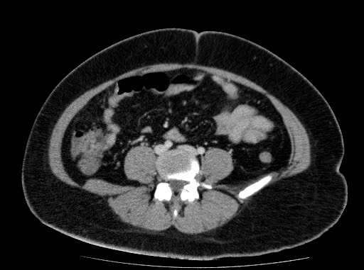 File:Acute pancreatitis (Radiopaedia 69236-79012 Axial C+ portal venous phase 60).jpg