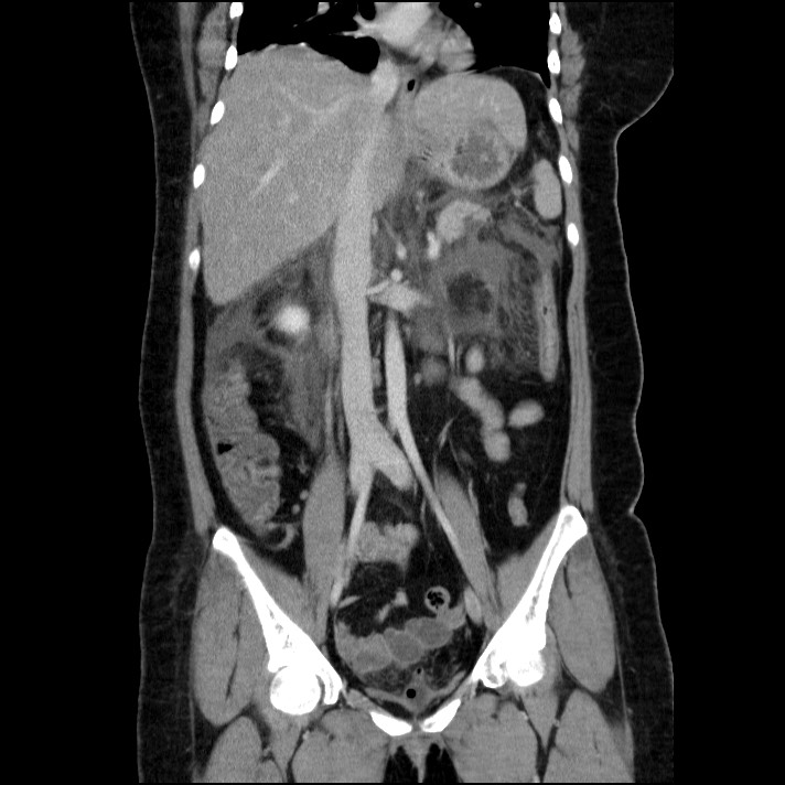 Acute pancreatitis (Radiopaedia 69236-79012 Coronal C+ portal venous phase 39).jpg