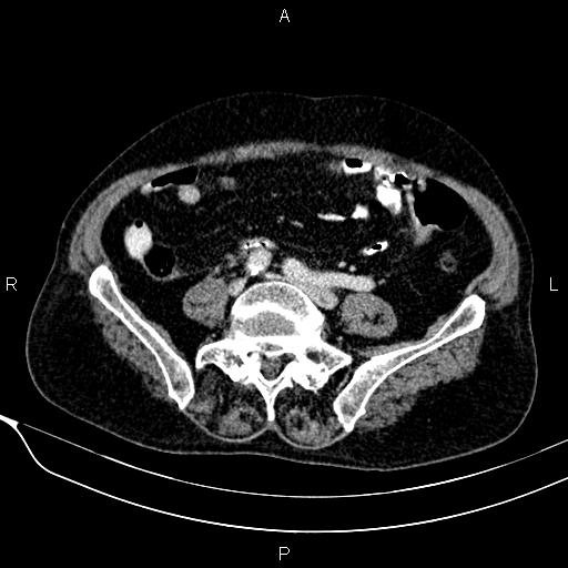 File:Acute pancreatitis (Radiopaedia 85146-100701 Axial C+ portal venous phase 46).jpg
