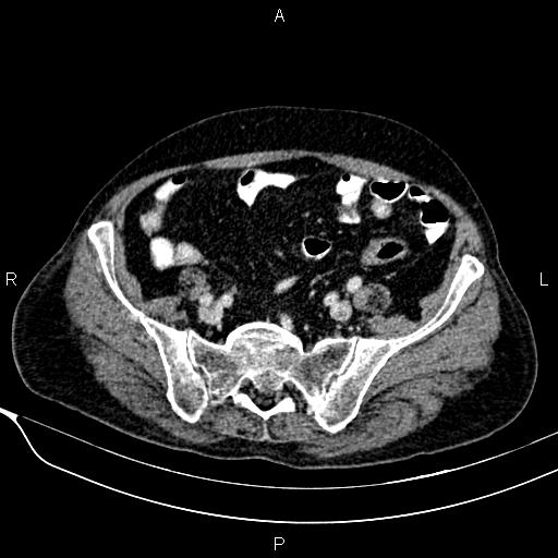 File:Acute pancreatitis (Radiopaedia 85146-100701 Axial C+ portal venous phase 50).jpg