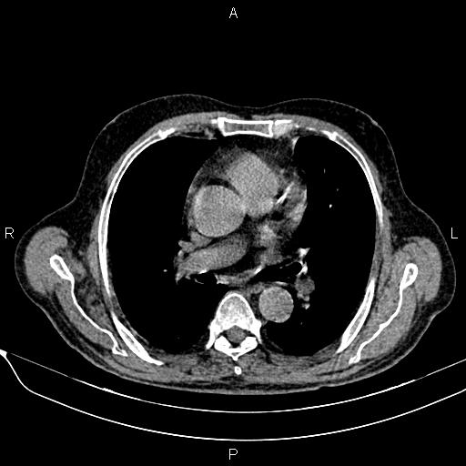 Acute pancreatitis (Radiopaedia 85146-100701 Axial non-contrast 3).jpg