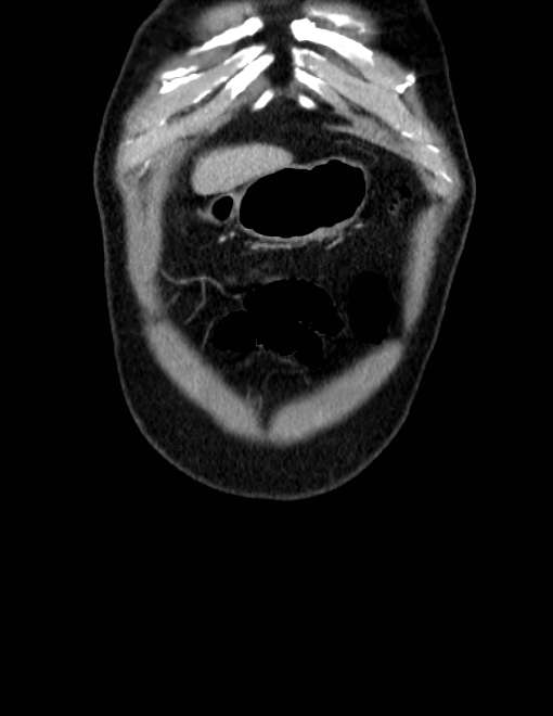 Acute pancreatitis - Balthazar E (Radiopaedia 23080-23110 Coronal C+ portal venous phase 3).jpg