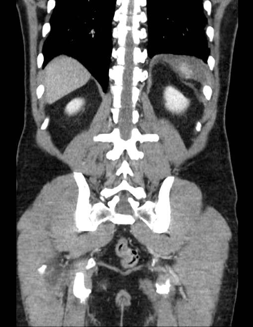 Acute pancreatitis - Balthazar E (Radiopaedia 23080-23110 Coronal C+ portal venous phase 64).jpg