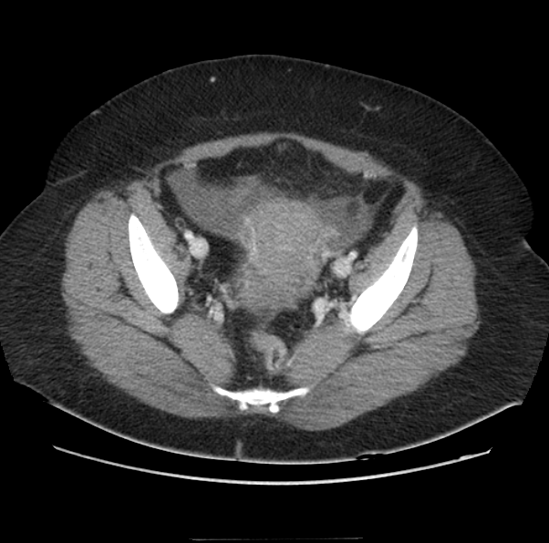 Acute pancreatitis - Balthazar E (Radiopaedia 29016-29377 Axial C+ portal venous phase 63).png