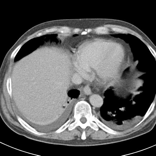 Acute pancreatitis and walled-off necrosis (Radiopaedia 29888-30403 Axial C+ delayed 11).jpg