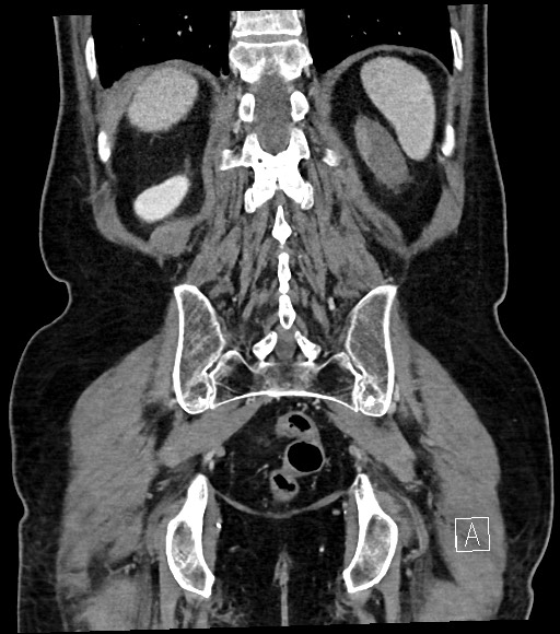 Acute renal infarction (Radiopaedia 59375-66736 Coronal C+ portal venous phase 50).jpg