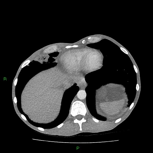 File:Acute right lung abscess (Radiopaedia 34806-36258 Axial C+ arterial phase 155).jpg
