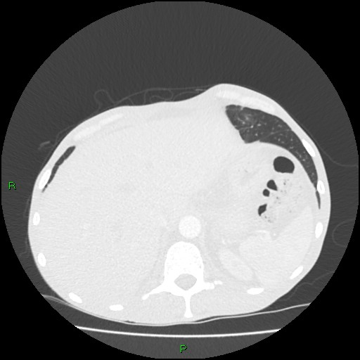 Acute right lung abscess (Radiopaedia 34806-36258 Axial lung window 174).jpg