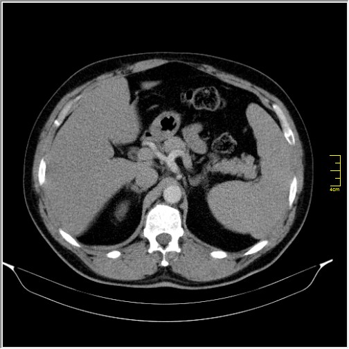 Acute right sided diverticulitis (Radiopaedia 65249-74268 Axial C+ portal venous phase 20).JPG
