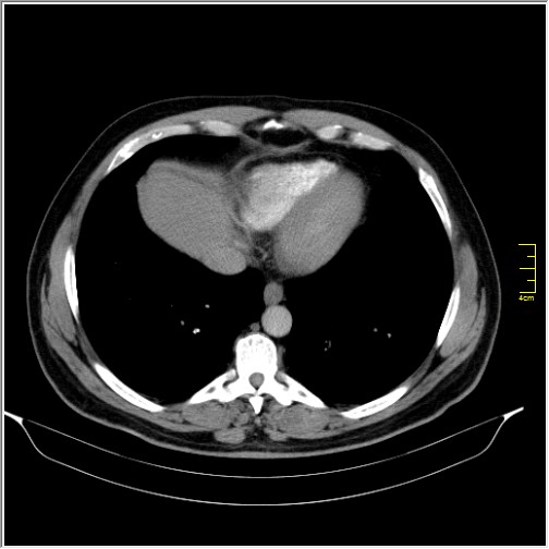 File:Acute right sided diverticulitis (Radiopaedia 65249-74268 Axial C+ portal venous phase 3).JPG