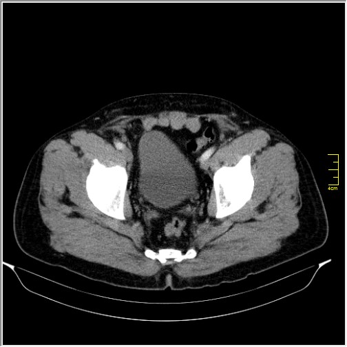 File:Acute right sided diverticulitis (Radiopaedia 65249-74268 Axial C+ portal venous phase 72).JPG