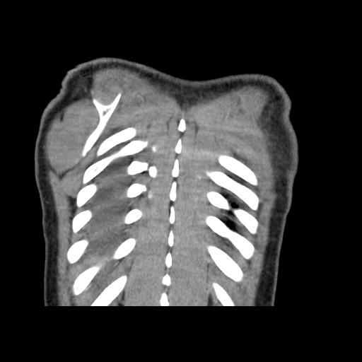 Acute segmental pulmonary emboli and pulmonary infarction (Radiopaedia 62264-70444 Coronal C+ CTPA 55).jpg
