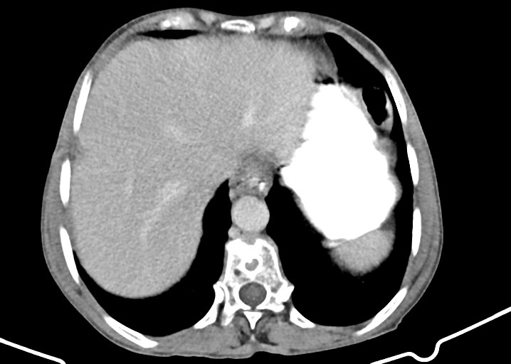 File:Acute small bowel (ileal) volvulus (Radiopaedia 71740-82139 Axial 129).jpg