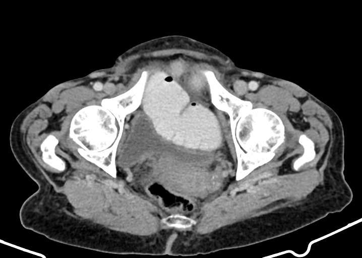Acute small bowel (ileal) volvulus (Radiopaedia 71740-82139 Axial C+ portal venous phase 185).jpg