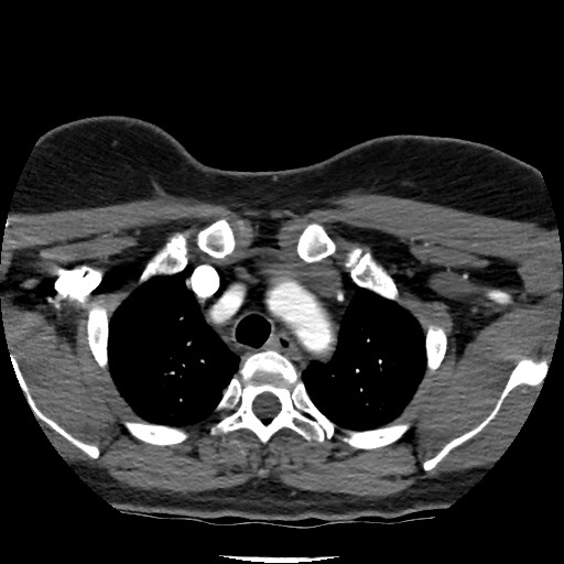 Acute subarachnoid hemorrhage and accessory anterior cerebral artery (Radiopaedia 69231-79009 Axial C+ arterial phase 18).jpg