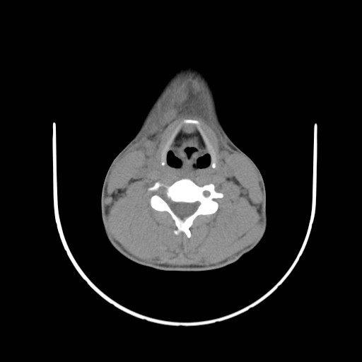 File:Acute submandibular sialadenitis secondary to ductal stone (Radiopaedia 27999-28267 Axial non-contrast 20).jpg