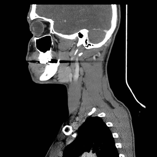 File:Acute submandibular sialadenitis secondary to ductal stone (Radiopaedia 27999-28267 Sagittal C+ delayed 34).jpg