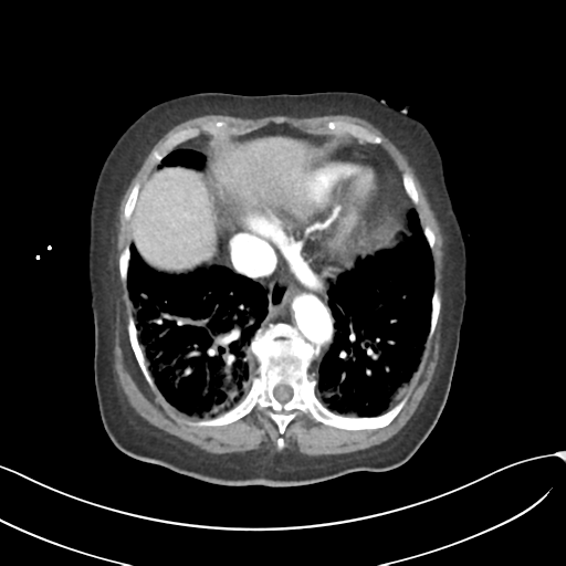 Acute superior mesenteric artery occlusion (Radiopaedia 43926-47418 Axial C+ portal venous phase 8).png