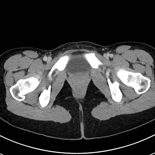Acute uncomplicated appendicitis (Radiopaedia 61374-69304 Axial C+ portal venous phase 131).jpg