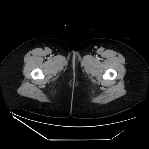 File:Acute uncomplicated appendicitis (Radiopaedia 73704-84499 Axial C+ portal venous phase 183).jpg