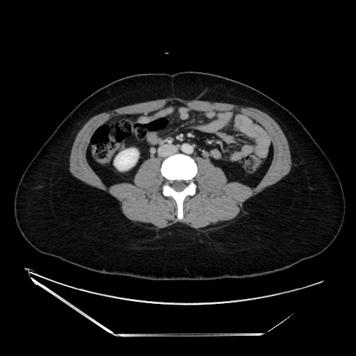 Acute uncomplicated appendicitis (Radiopaedia 73704-84499 Axial C+ portal venous phase 84).jpg